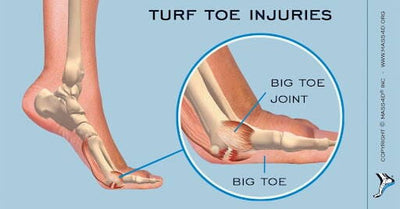Turf Toe - Everything You Need To Know